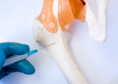 Un hidrogel impreso con láser podría revolucionar el tratamiento de fracturas óseas